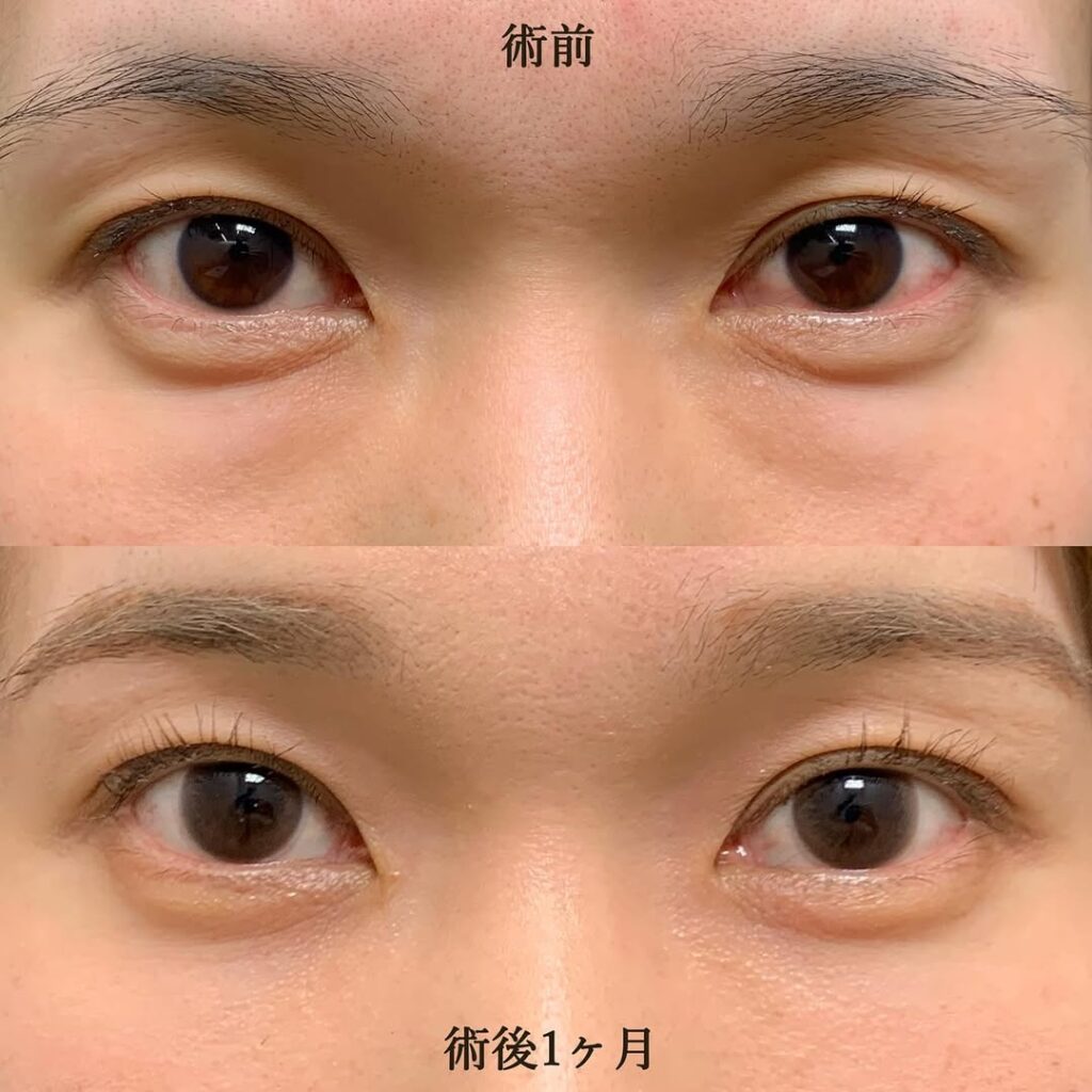 経結膜脱脂＋脂肪注入