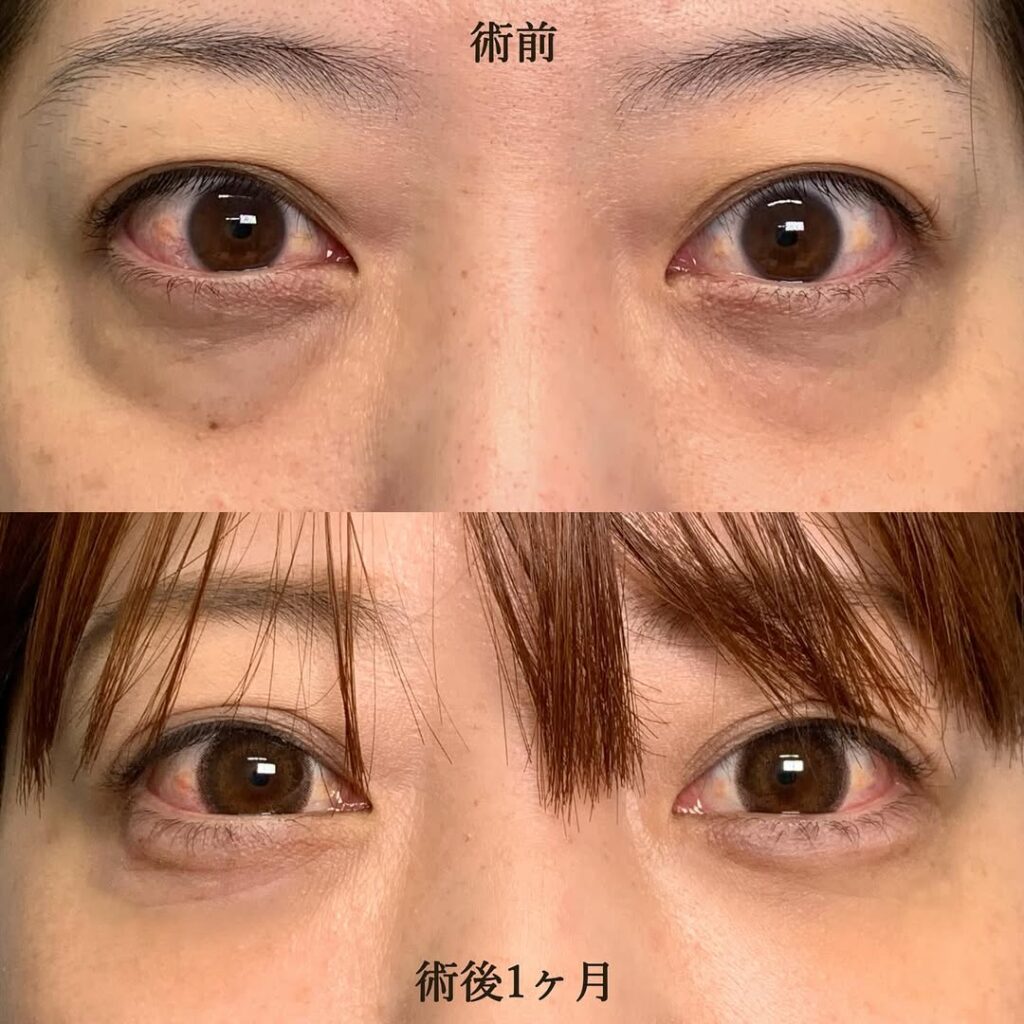 経結膜脱脂＋脂肪注入