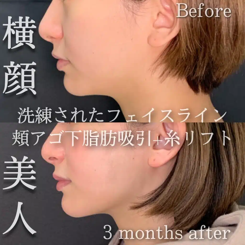 脂肪吸引　糸リフト