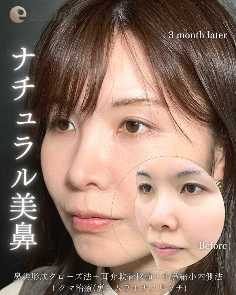 eクリニック福岡院の鼻尖形成クローズ法と耳介軟骨移植と小鼻縮小内側法と裏ハムラ法と目の下にナノリッチを注入した症例写真（鼻整形）