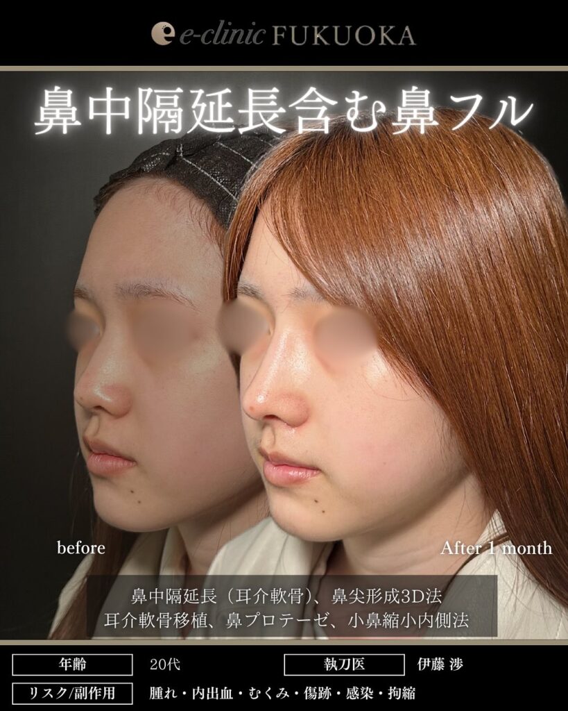 eクリニック福岡院の鼻中隔延長と鼻尖形成3D法と耳介軟骨移植と鼻のプロテーゼと小鼻縮小内側法の症例写真（鼻整形）