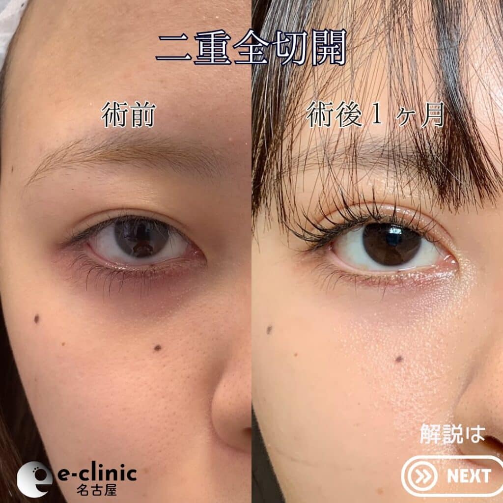 eclinic福岡院の全切開二重術