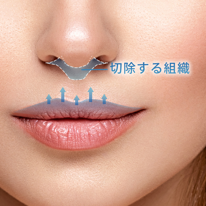 人中短縮の切除する組織の図解
