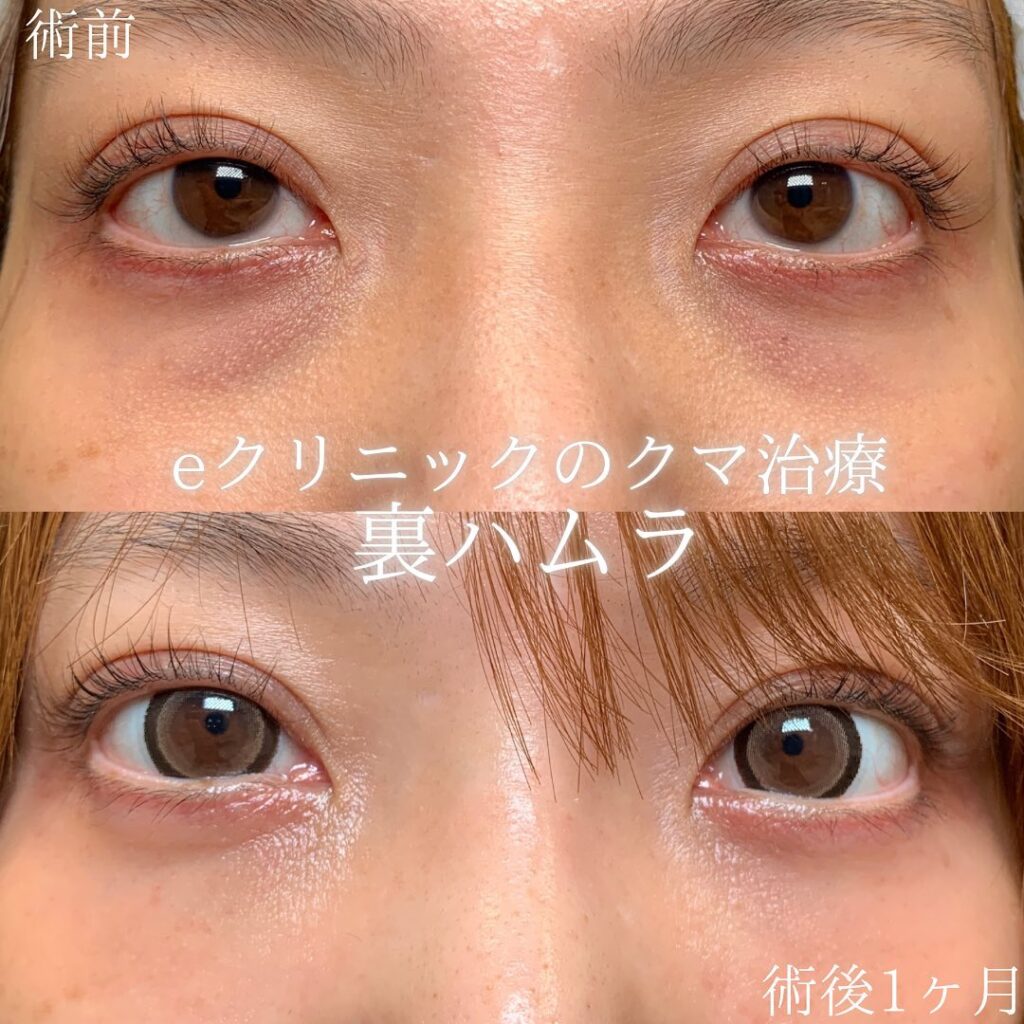 eクリニック福岡院の裏ハムラの症例画像(1)
