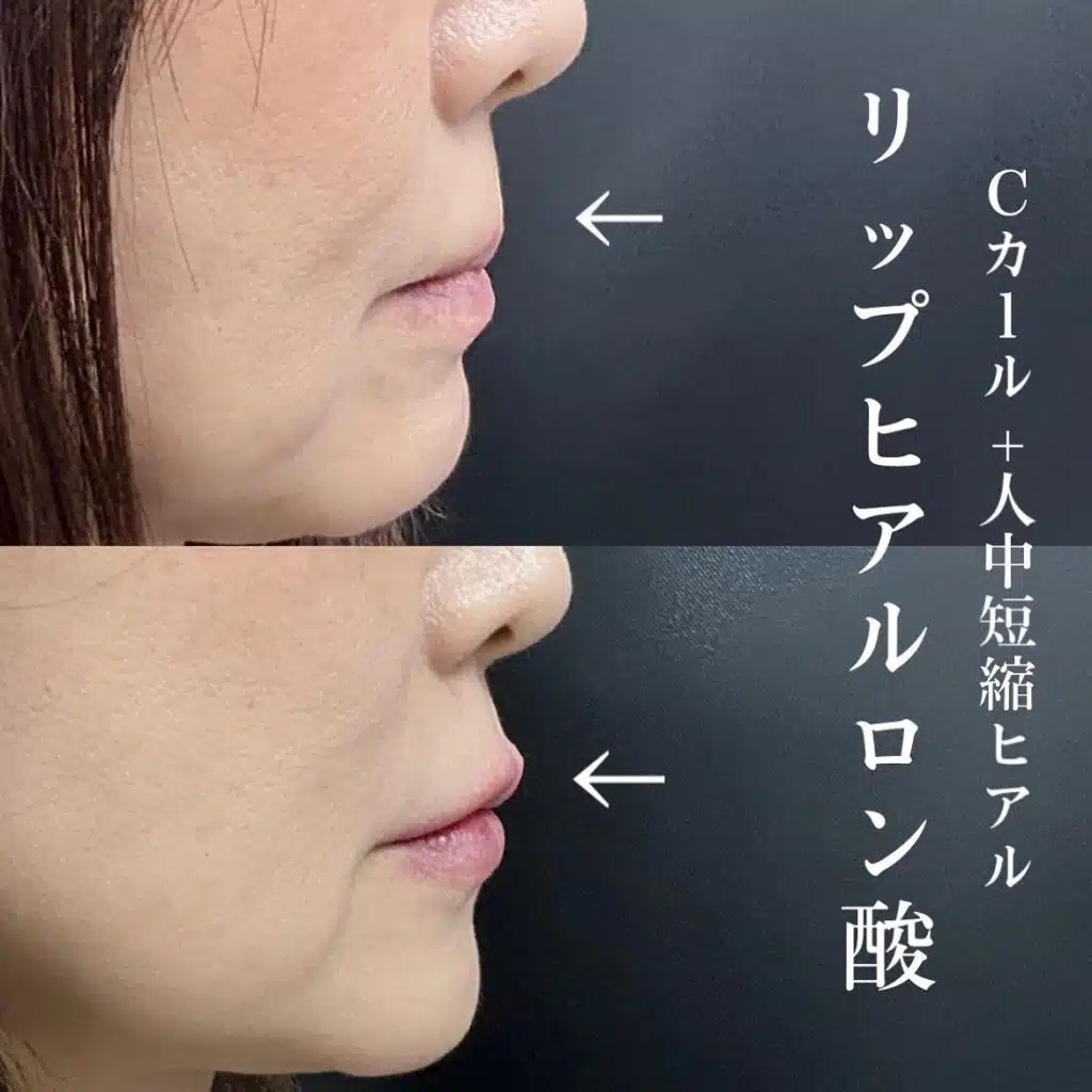唇ヒアルロン酸