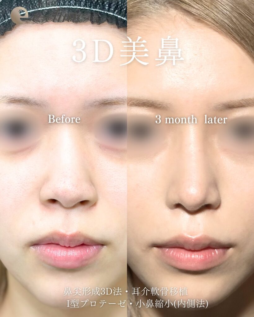 eクリニック福岡院の鼻尖形成3D法と軟骨膜移植とI型鼻プロテーゼと小鼻縮小（内側法）の症例写真（鼻整形）