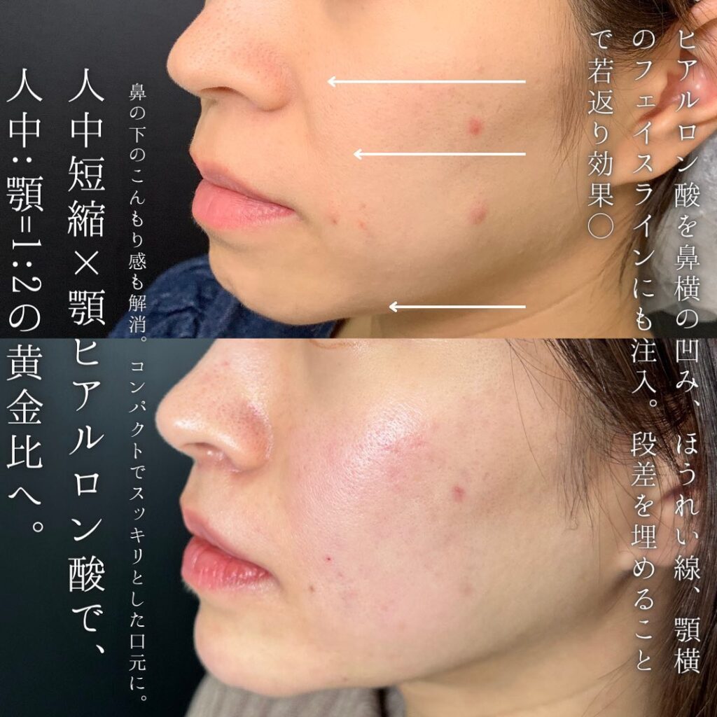 福岡の人中短縮と顎のヒアルロン酸注入の３か月後の症例