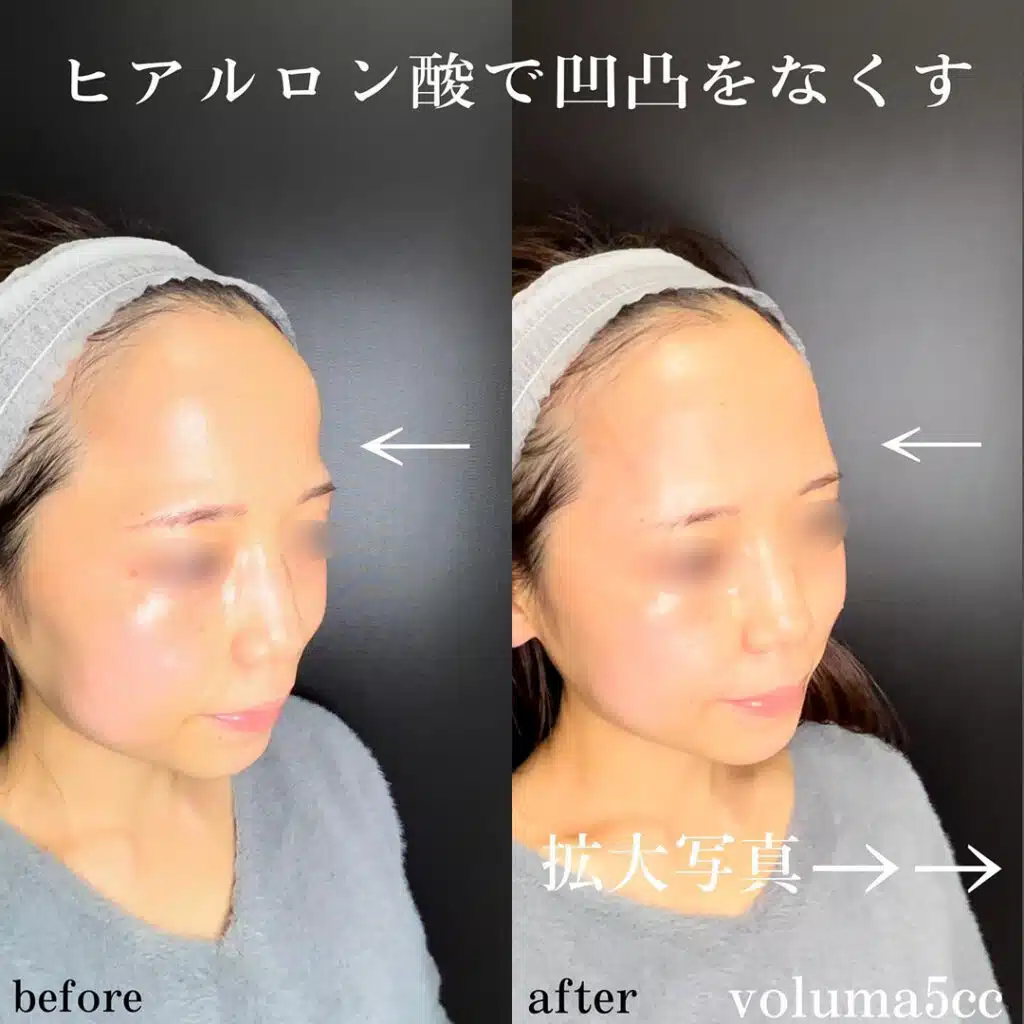 こめかみ ヒアルロン酸