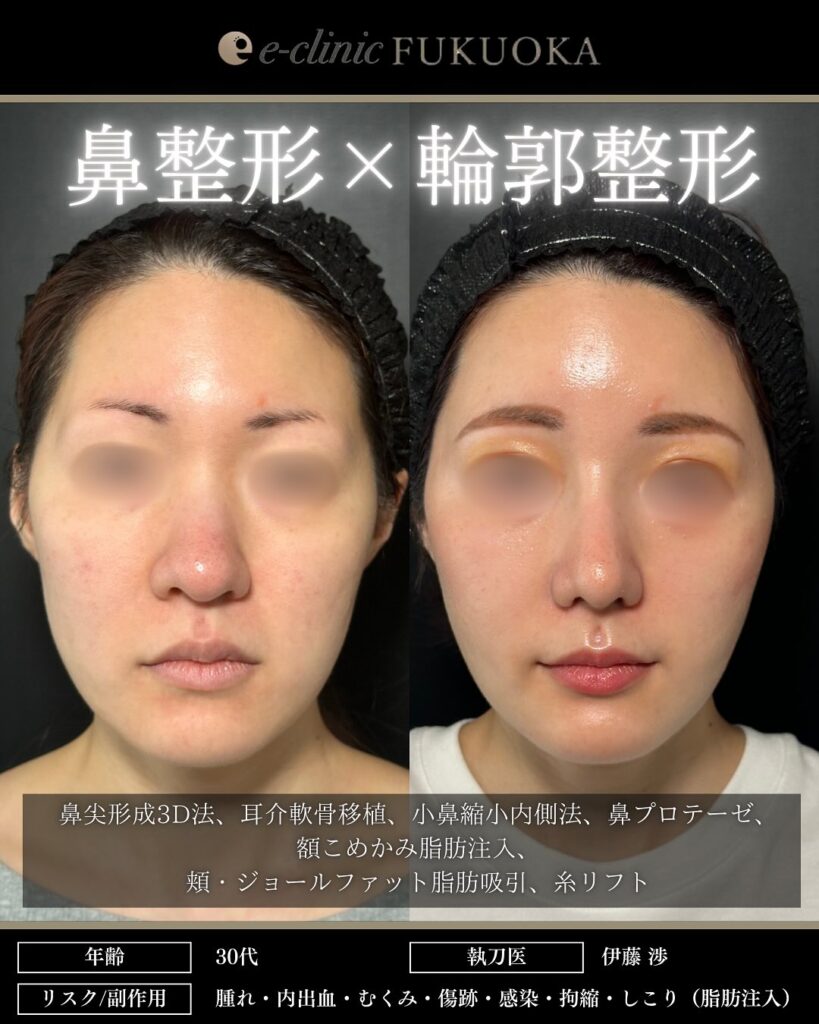 eクリニック福岡院の鼻尖形成3D法と耳介軟骨移植と小鼻縮小内側法と鼻プロテーゼと額こめかみ脂肪注入と頬・ジョールファット脂肪吸引と糸リフトの症例写真（鼻整形×輪郭整形）