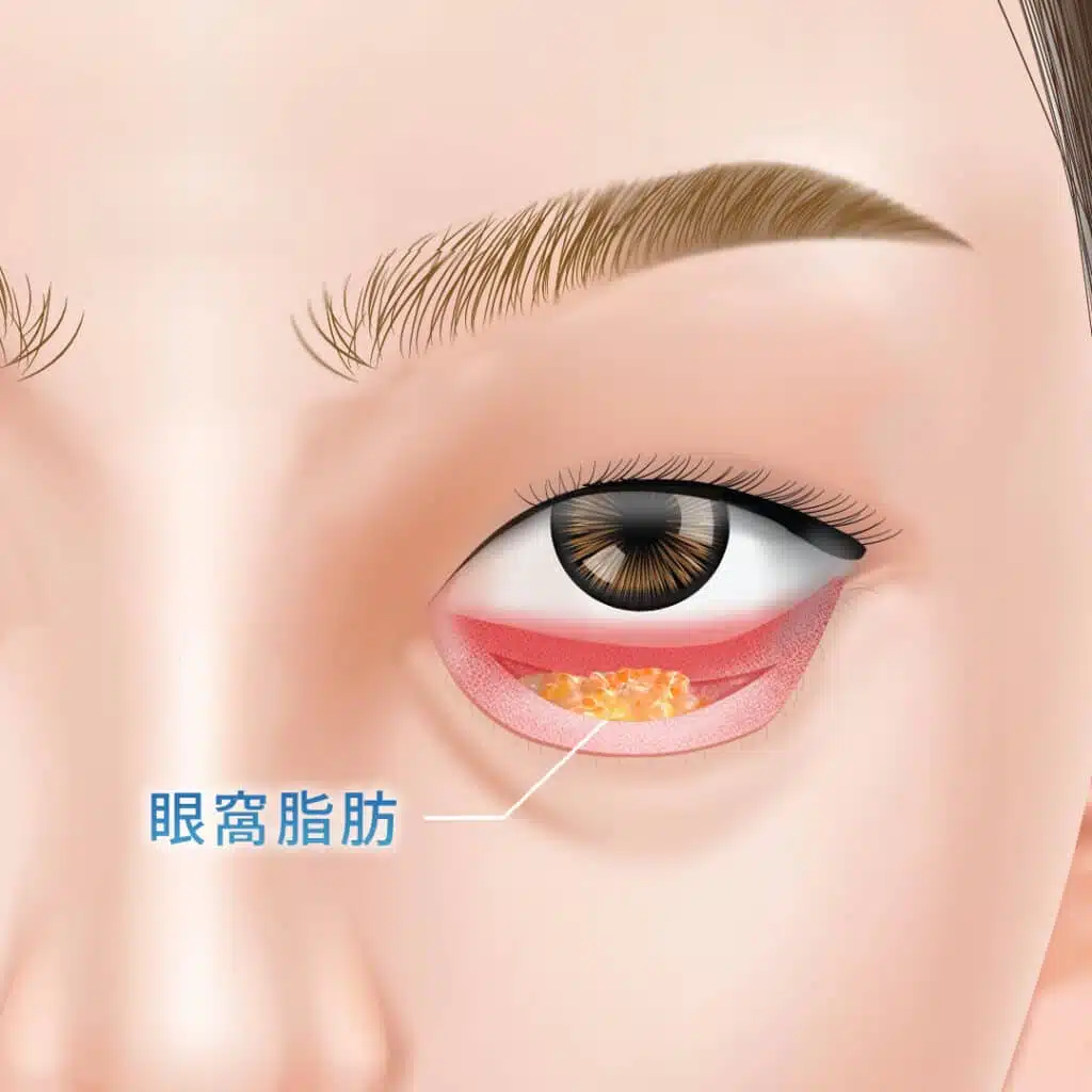 裏ハムラで眼窩脂肪を露出させている状態の図解