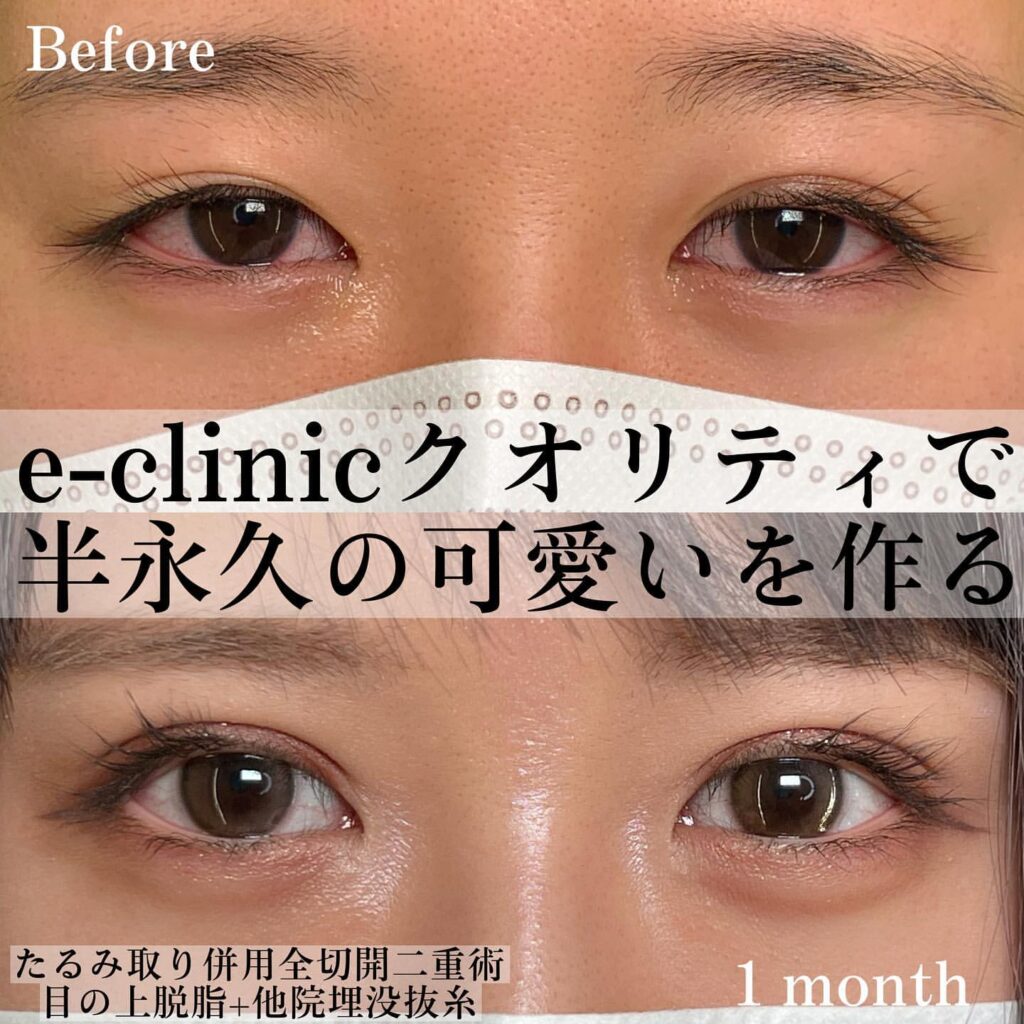 eclinic福岡院のたるみ取り併用全切開二重術+目の上脱脂+他院埋没抜糸