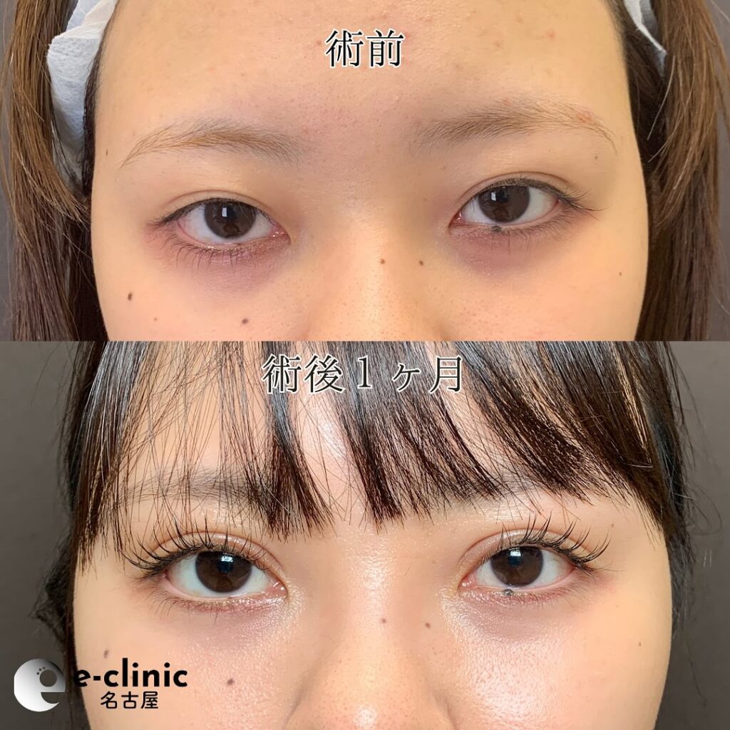 eclinic福岡院の全切開二重術