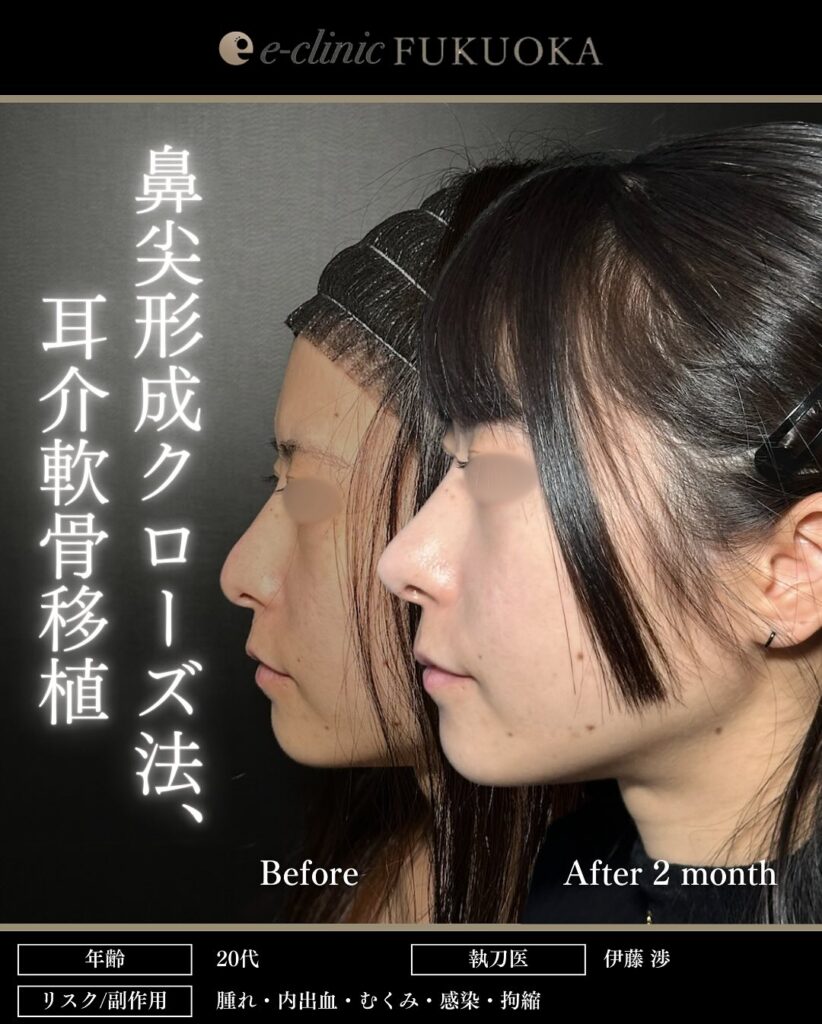 eクリニック福岡院の鼻尖形成クローズ法と耳介軟骨移植の症例写真（鼻整形）