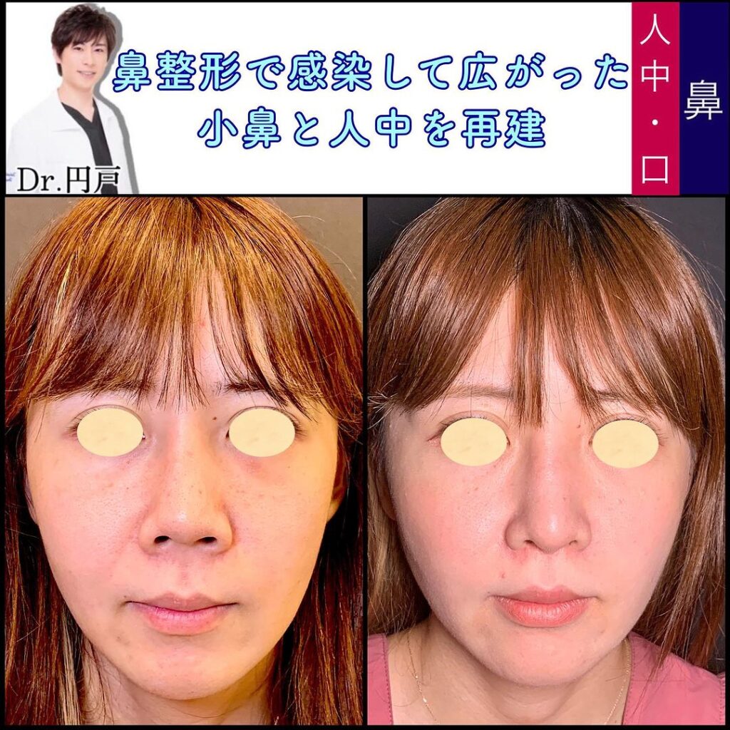 人中短縮と小鼻縮小と鼻柱を再建した症例写真