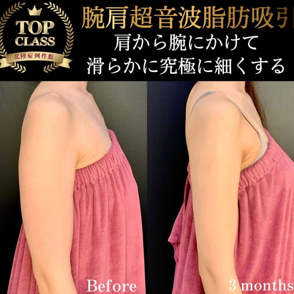 eclinic福岡院の腕脂肪吸引の症例写真
