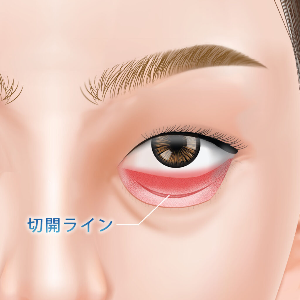 裏ハムラの切開ライン図解