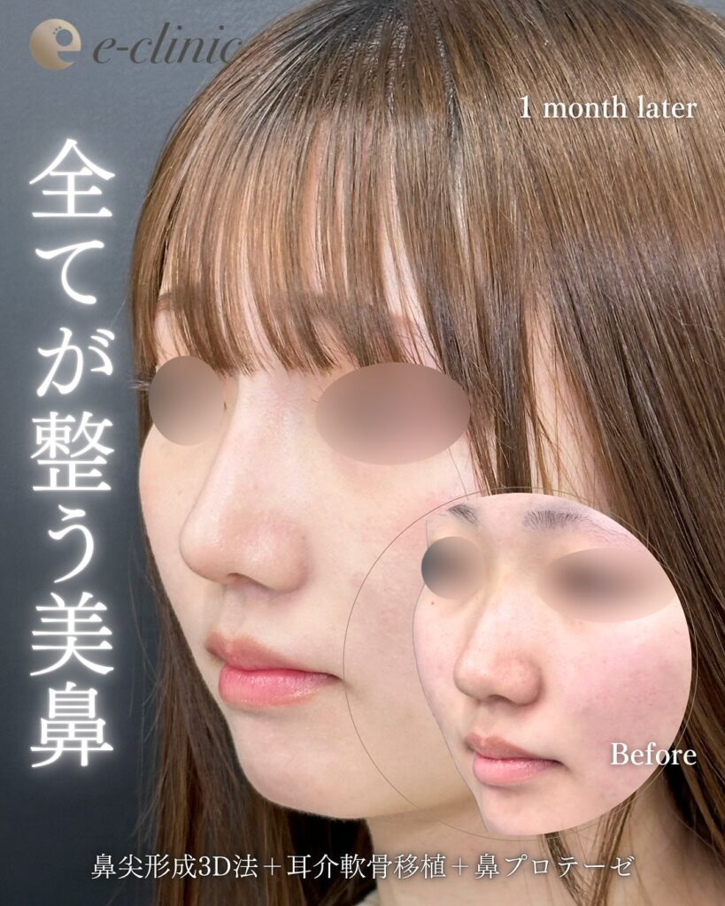 eクリニック福岡院の鼻尖形成3D法と鼻尖部と鼻背部筋膜移植または自家真皮移植と鼻プロテーゼの症例症例