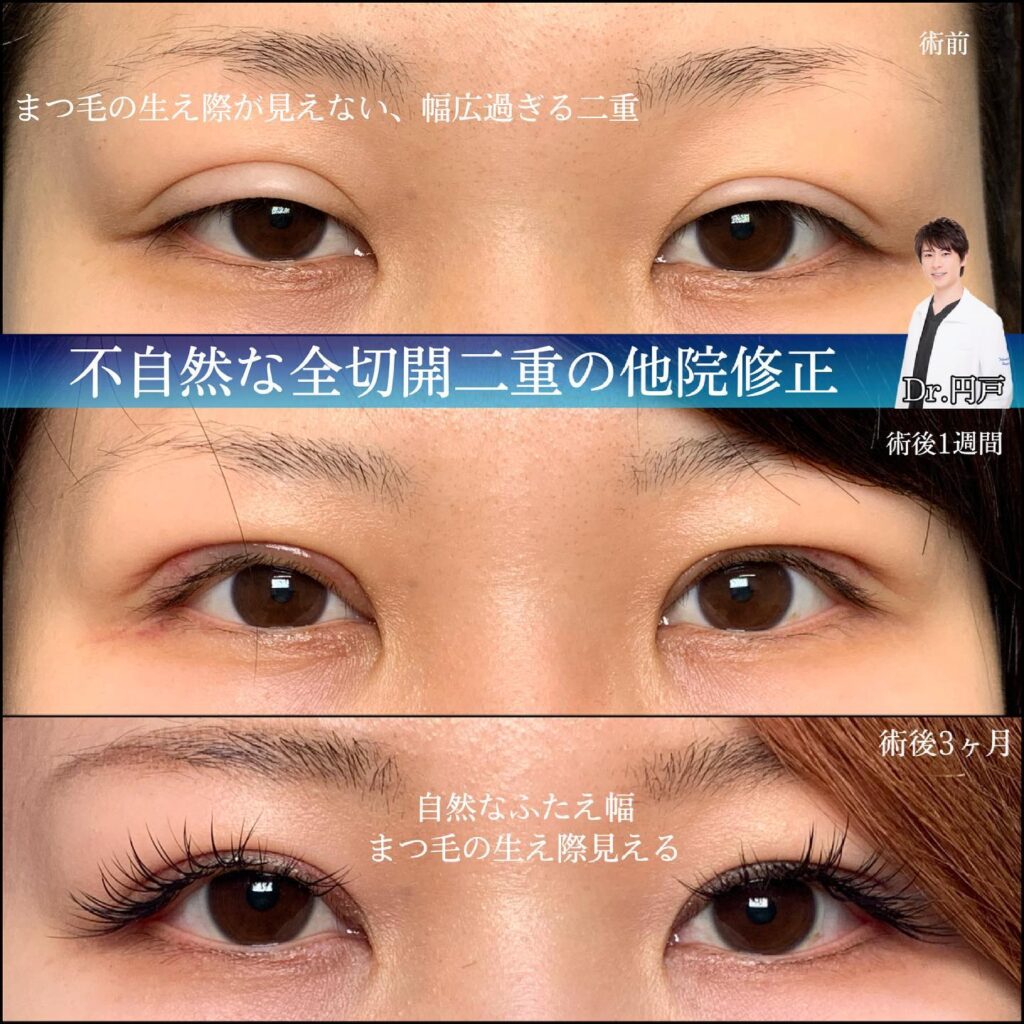eclinic福岡院の全切開二重術の他院修正