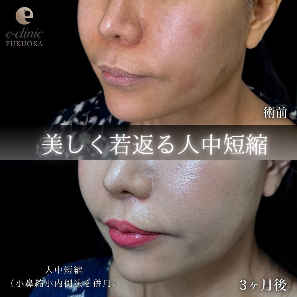 若返り目的の人中短縮手術