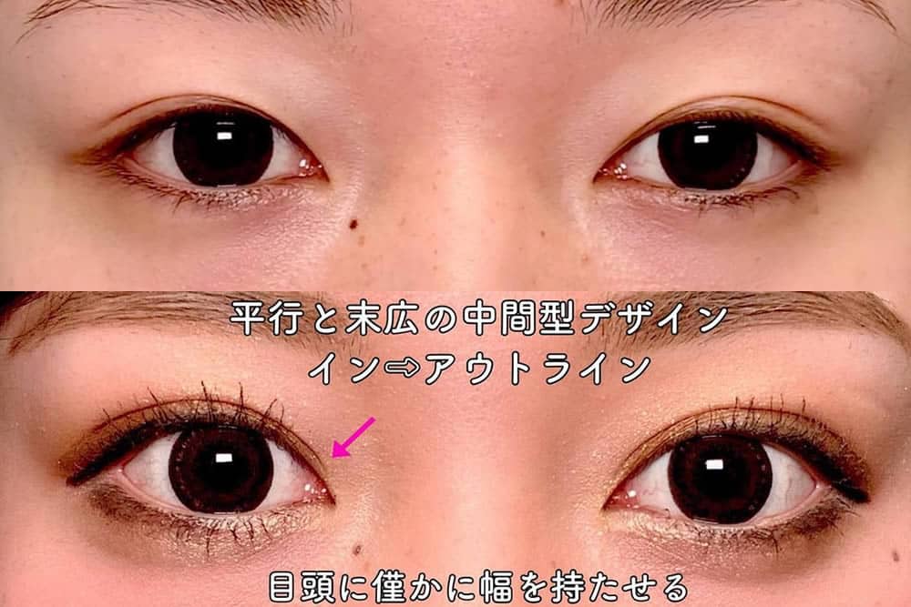 eclinic福岡院の全切開二重術