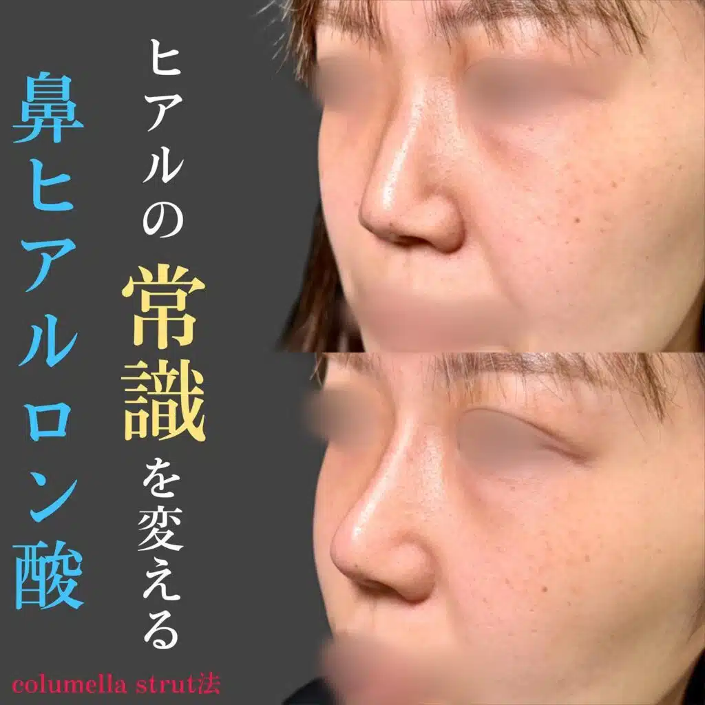 鼻ヒアルロン酸