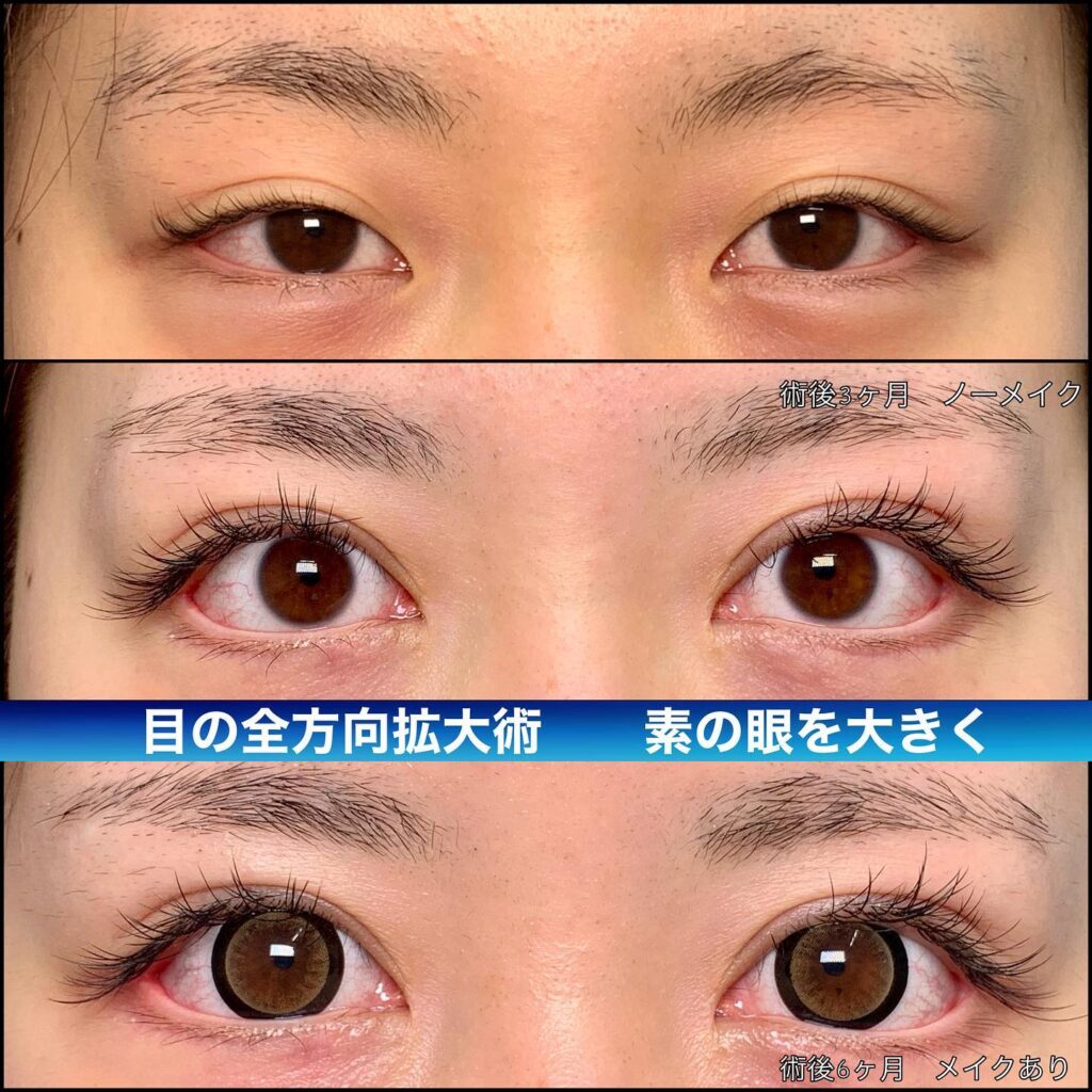 eclinic福岡院の全切開二重術