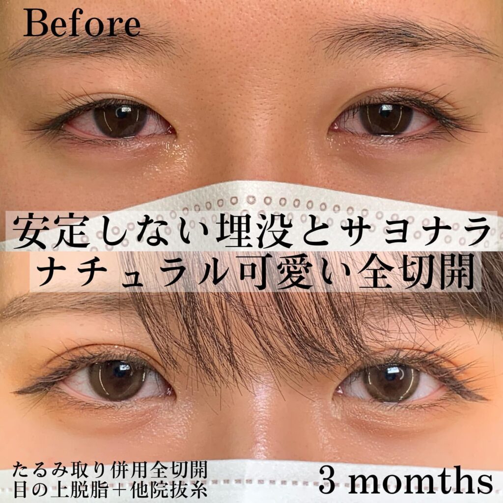 eclinic福岡院のたるみ取り併用全切開二重術+目の上脱脂+他院抜糸