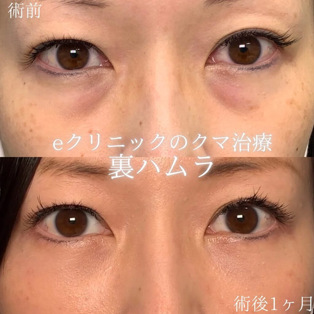 eクリニック福岡院の裏ハムラの症例画像(3)