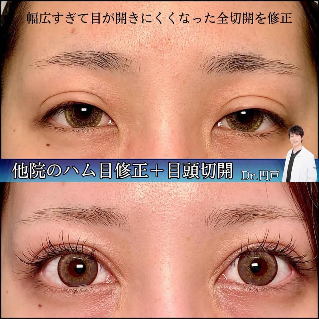 eclinic福岡院の全切開二重術の他院修正(ハム目)+目頭切開
