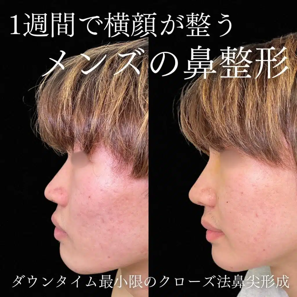 男 クローズ法鼻尖形成