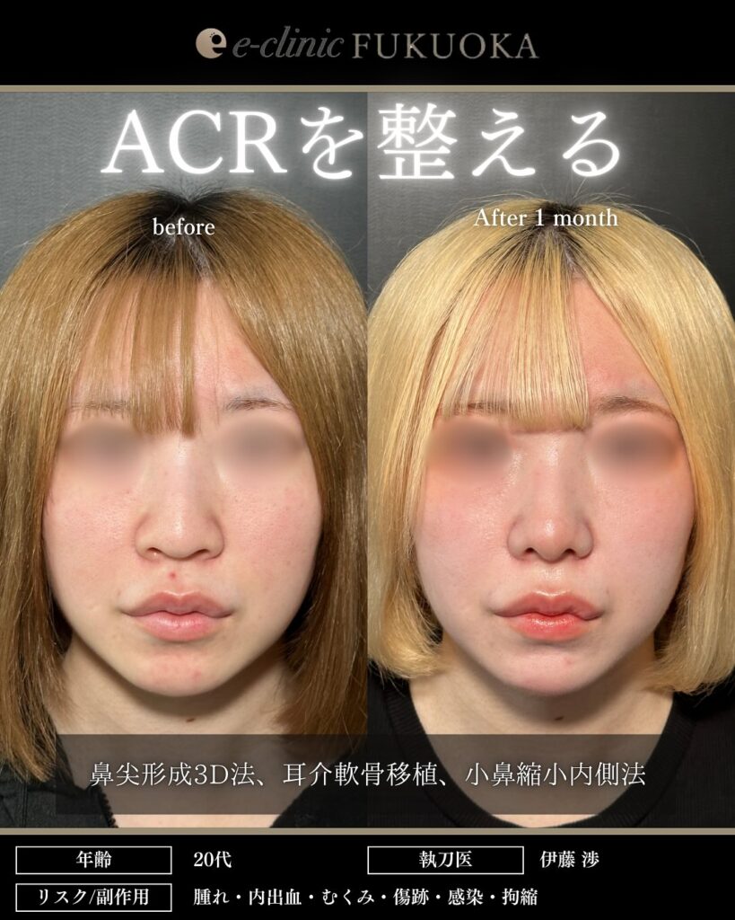 eクリニック福岡院の鼻尖形成3D法と耳介軟骨移植と小鼻縮小の症例写真（鼻整形）