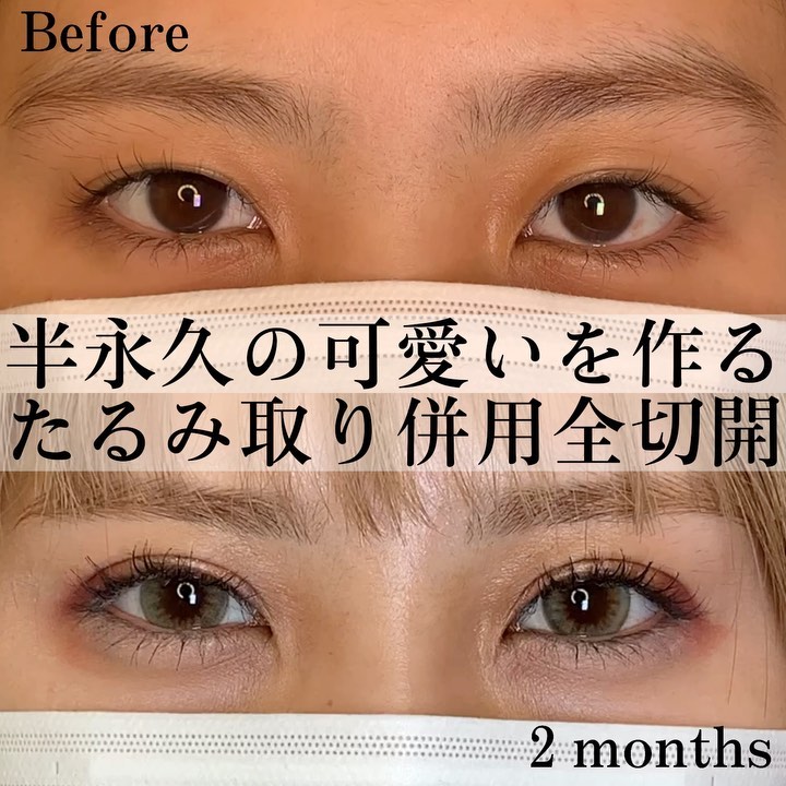 eclinic福岡院のたるみ取り併用全切開二重術