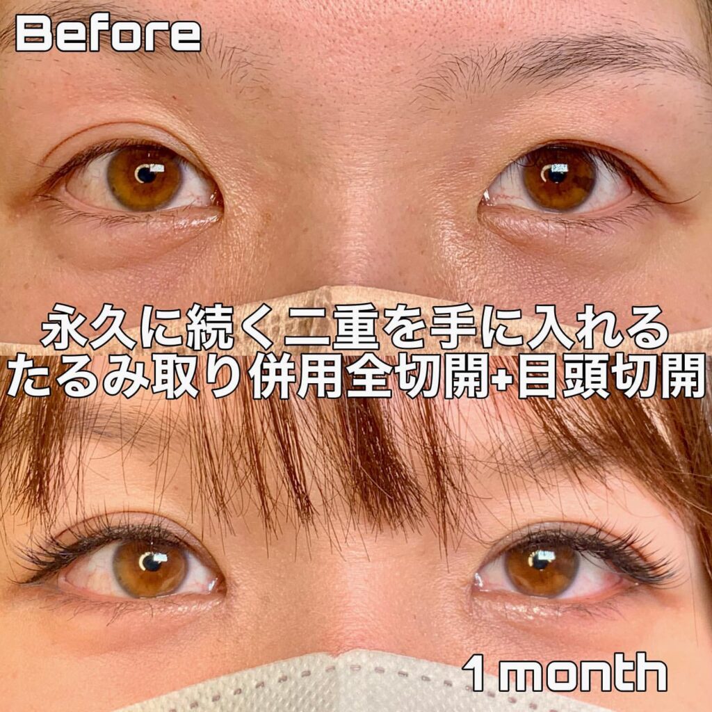 eclinic福岡院のたるみ取り併用全切開二重術+目頭切開
