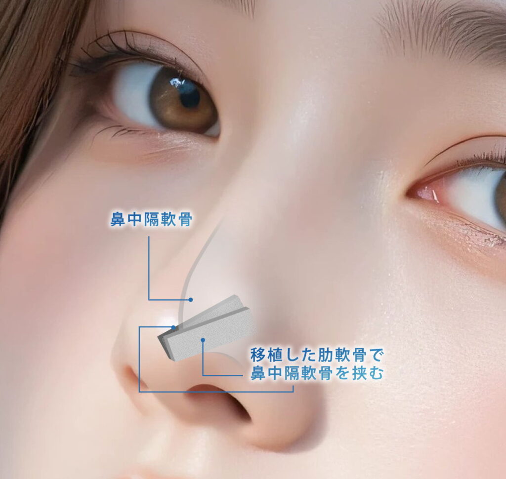 肋軟骨2枚で鼻中隔を挟んで鼻先を高くした図解