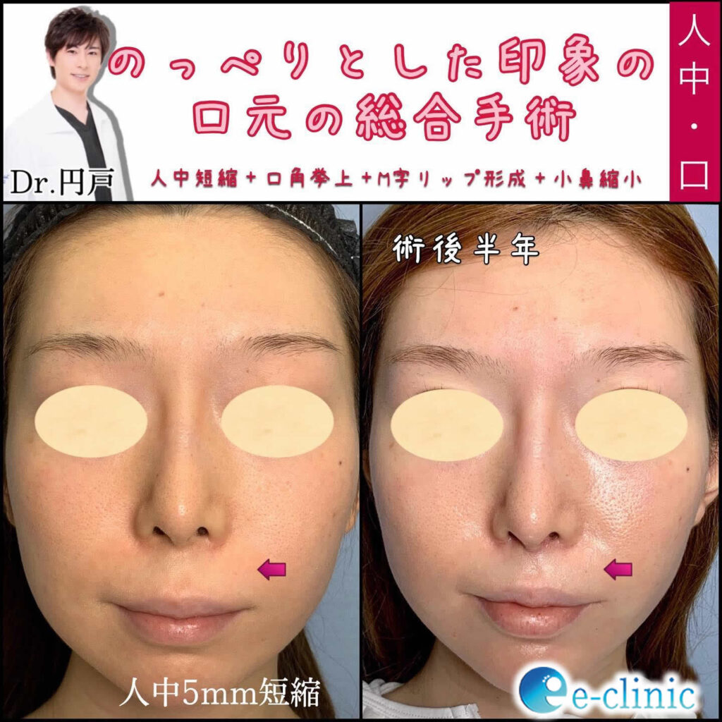 口角挙上とM字リップと人中短縮と小鼻縮小の症例写真