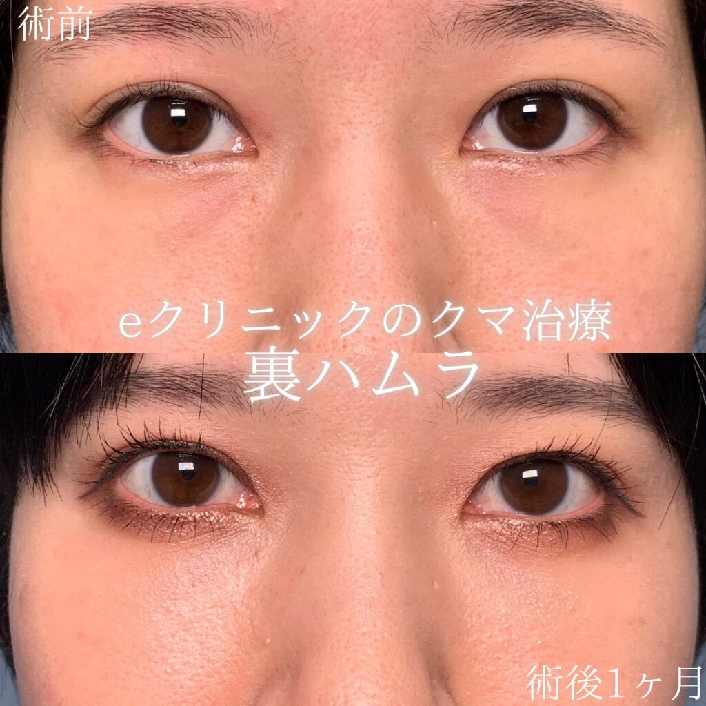 eクリニック福岡院の裏ハムラの症例画像(2)