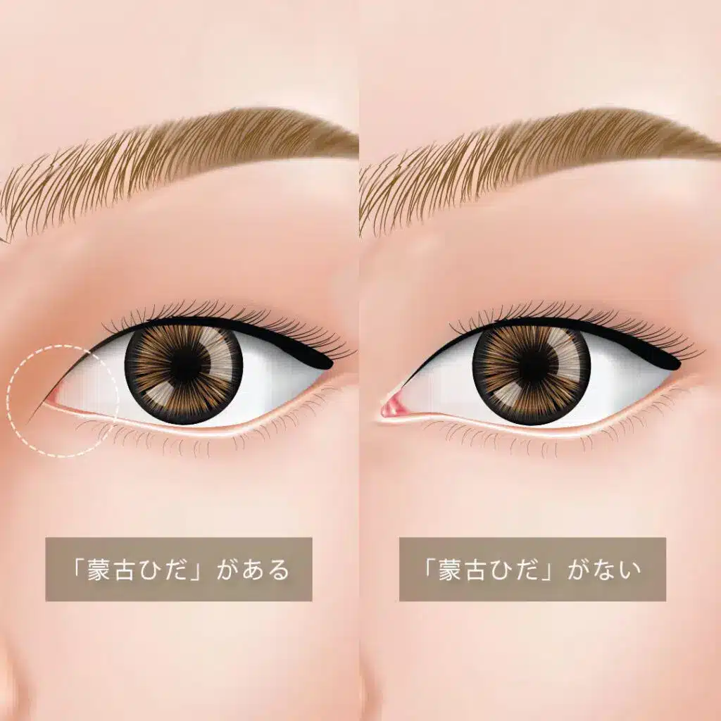 蒙古襞