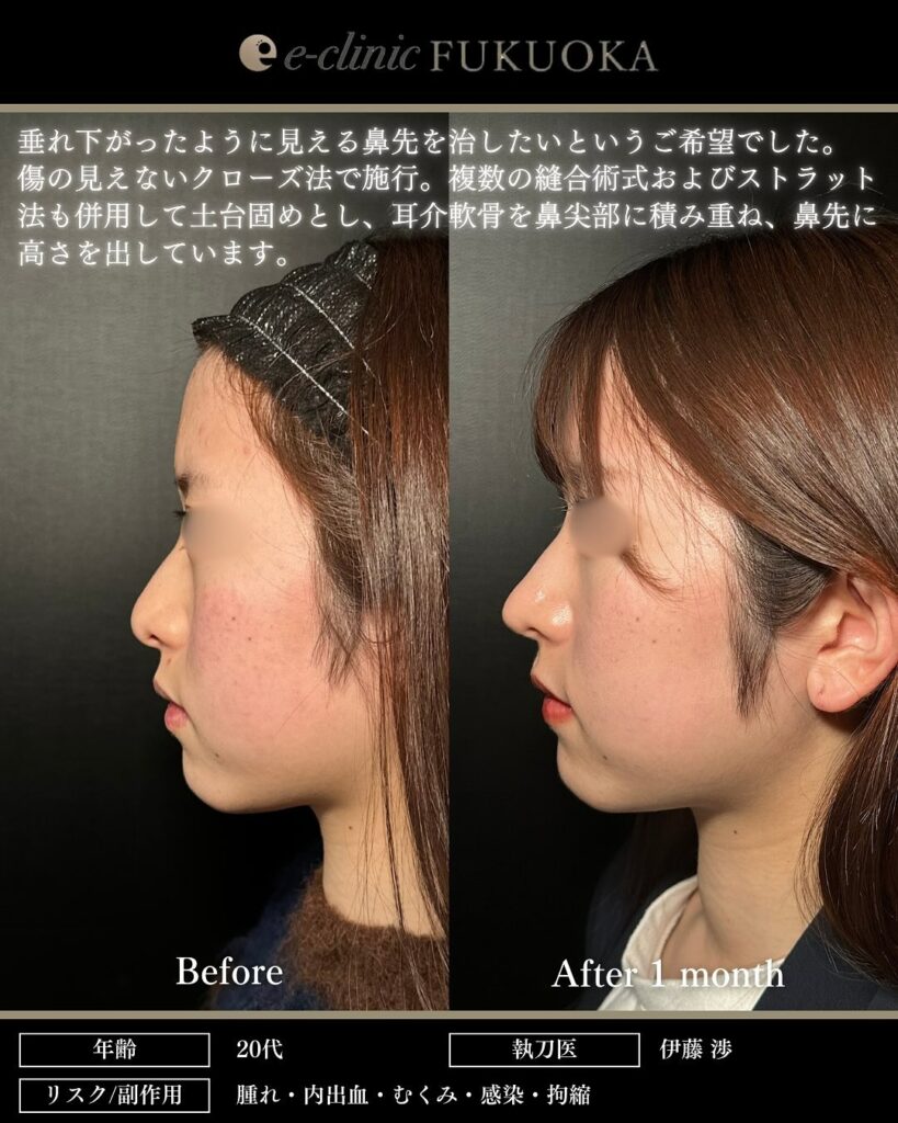 eクリニック福岡院の耳介軟骨移植の鼻の症例写真（鼻整形で団子鼻改善）（名医の伊藤渉が執刀）