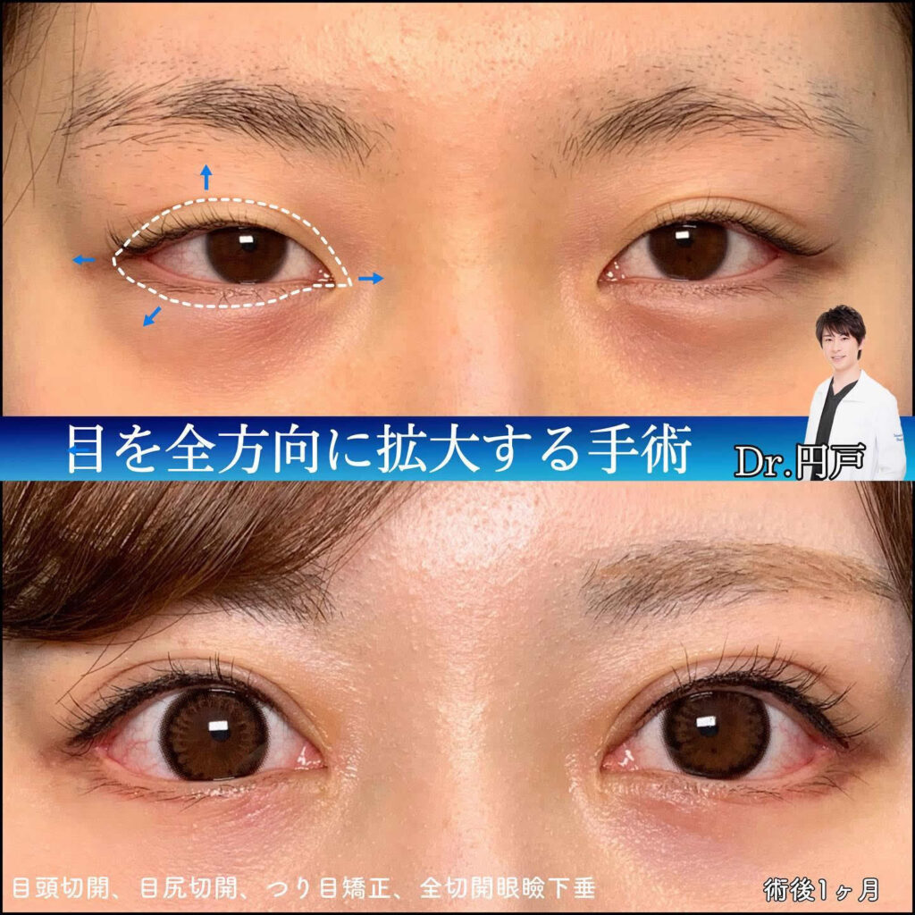 目頭切開と目尻切開と眼瞼下垂の手術の症例写真