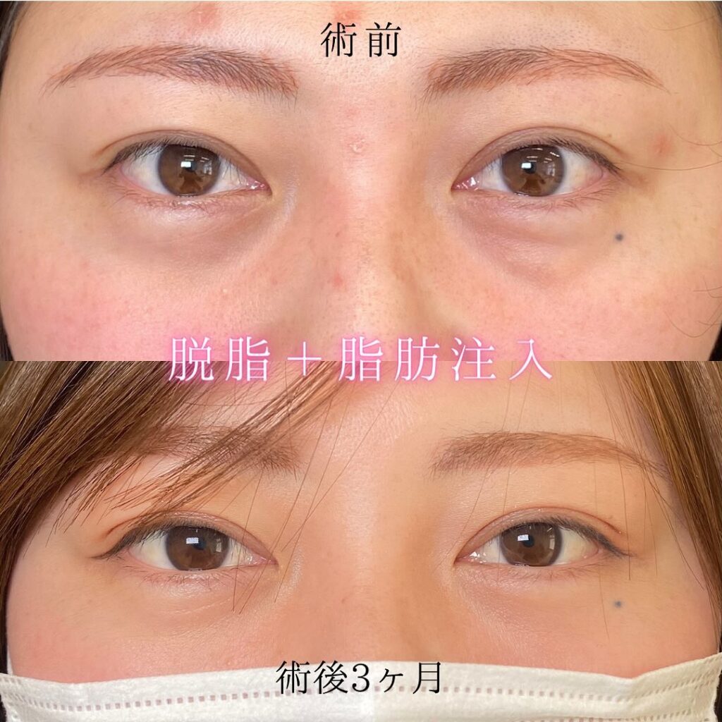 eクリニック福岡院の経血膜脱脂の症例写真(5)