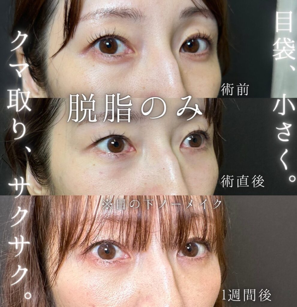 福岡で行った目の下の経結膜脱脂のダウンタイムの症例