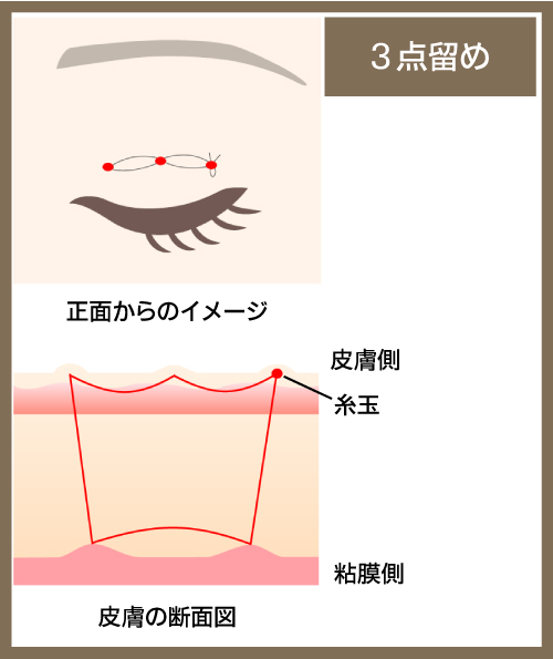 ３点留めの図解