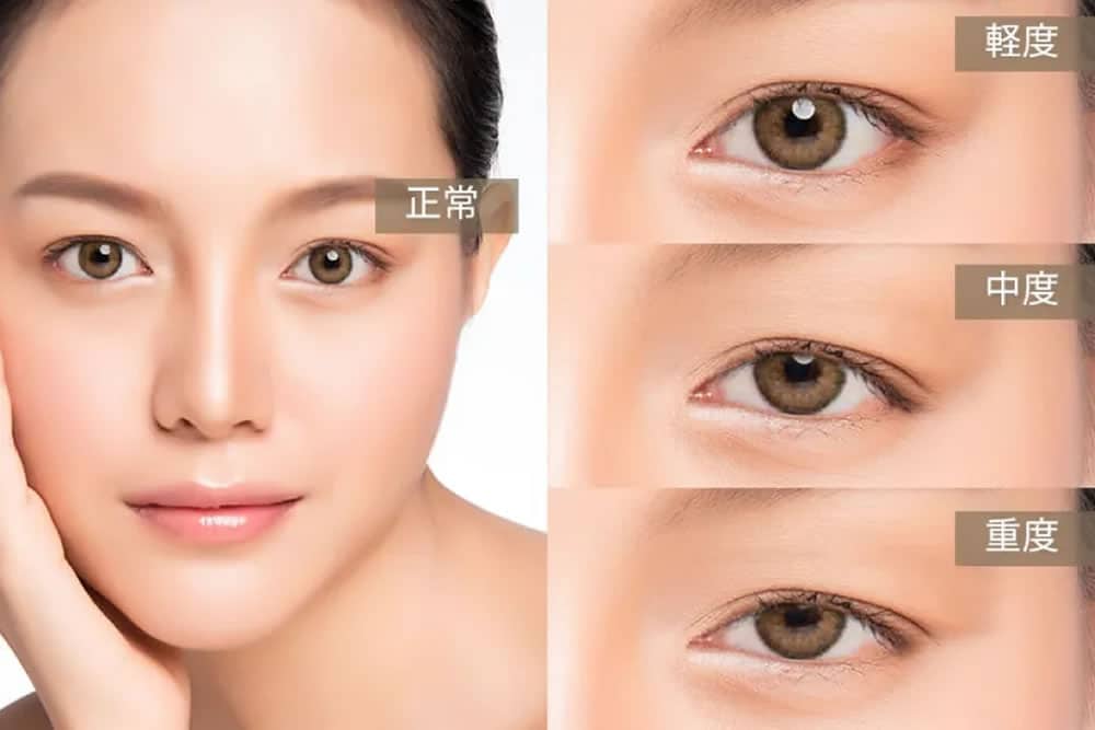 眼瞼下垂の説明図