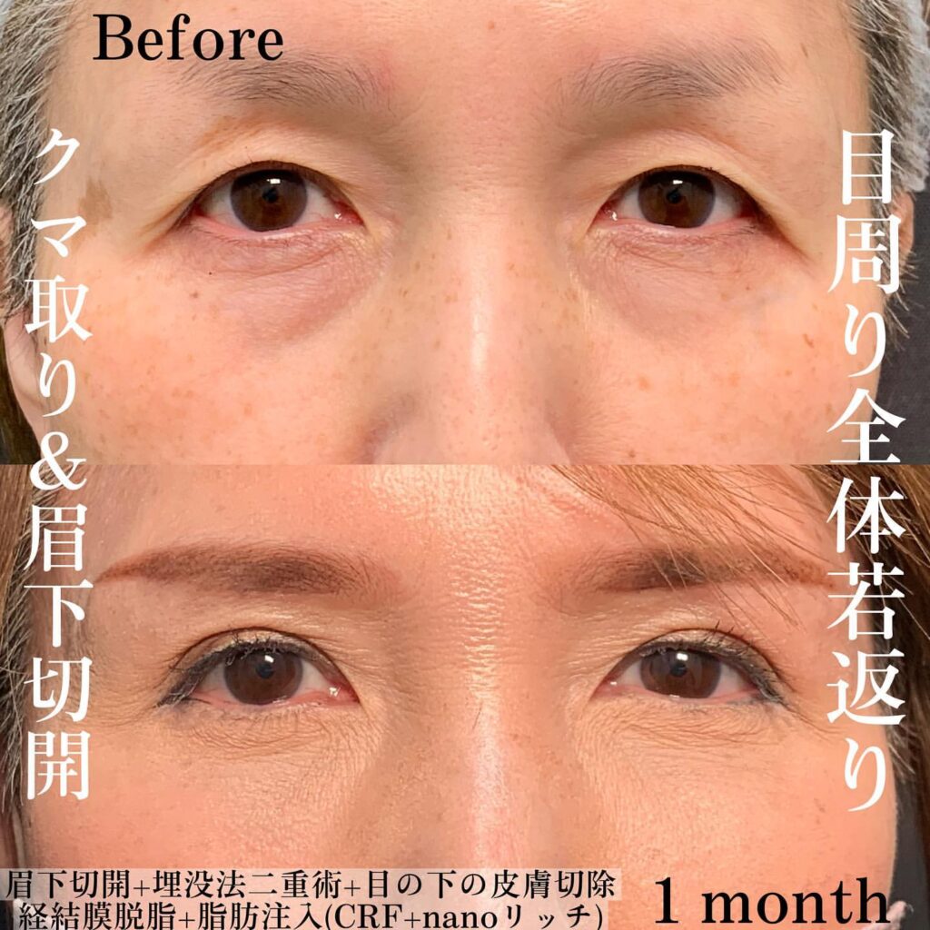 eクリニック福岡院の経血膜脱脂と脂肪注入と埋没法と眉下切開の症例写真(4)