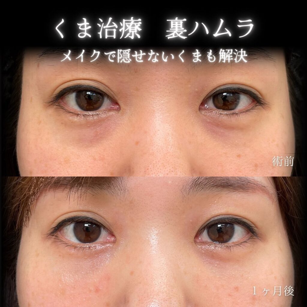 eclinic福岡院の表ハムラの症例画像（5）