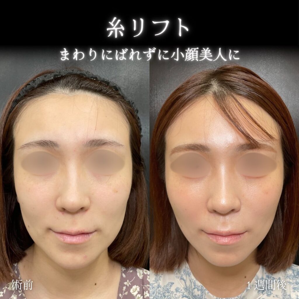 糸リフトの症例写真(名医の伊藤渉医師が執刀)