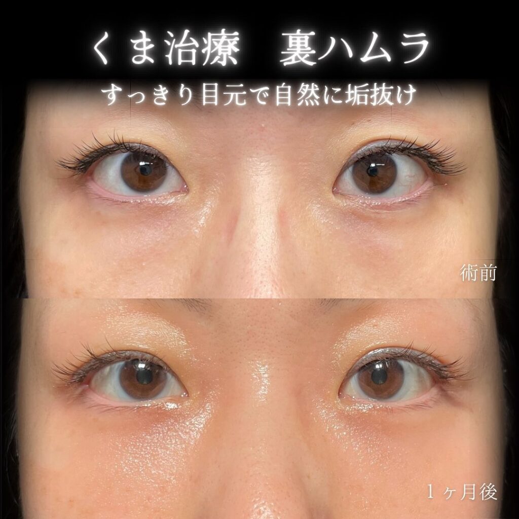 eclinic福岡院の表ハムラの症例画像（4）