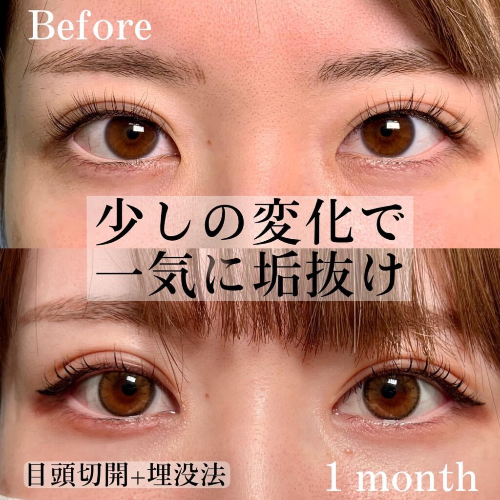 目頭切開と埋没法の症例写真（名医のeクリニック福岡院伊藤渉医師が執刀）