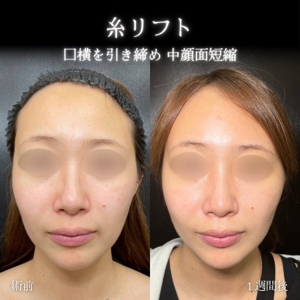 糸リフトの症例写真(名医の伊藤渉医師が執刀)