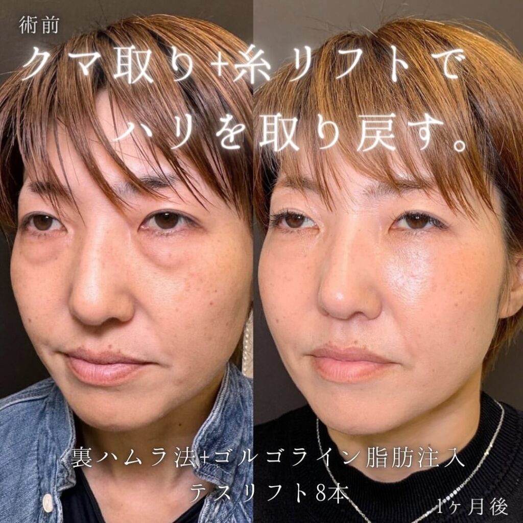 裏ハムラ法と脂肪注入と糸リフトの症例写真